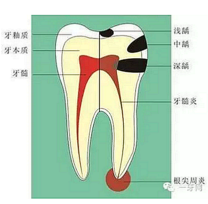 详解牙疼的原因分几种？