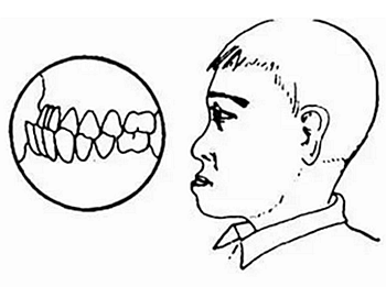 孩子怎么会长出双排牙？