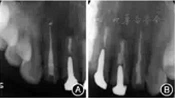 【病例讨论】根管治疗失败患牙再治疗一例（上）