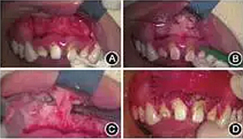 【病例讨论】根管治疗失败患牙再治疗一例（上）