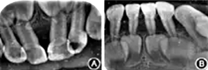 重型先天性中性粒细胞缺乏症伴牙周损害