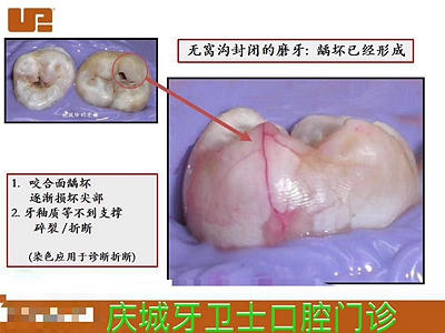 爱牙科普-来自临床的窝沟封闭