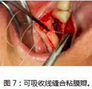 上颌窦瘘修补术——改良式旋转带蒂粘膜瓣修补术的应用