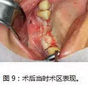 上颌窦瘘修补术——改良式旋转带蒂粘膜瓣修补术的应用