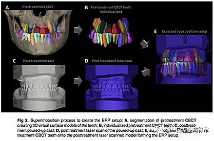 正畸文献阅读--正畸过程中牙根移动的三维监测