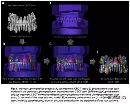 正畸文献阅读--正畸过程中牙根移动的三维监测