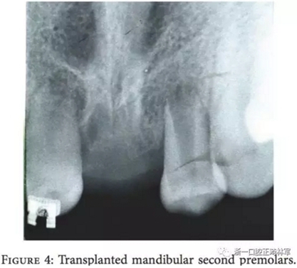 文献优秀正畸病例赏析--上颌中切牙区受伤后自体牙移植及正畸治疗13年随访病例