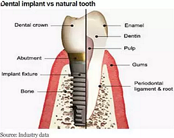 种植体，在全球牙科设备市场的变化！
