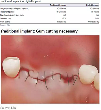 种植体，在全球牙科设备市场的变化！
