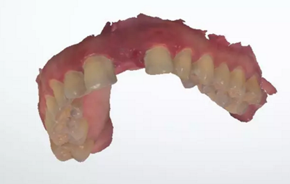 数字化修复病例分享 | 21单颗牙齿种植修复