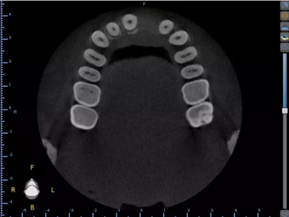 数字化修复病例分享 | 21单颗牙齿种植修复