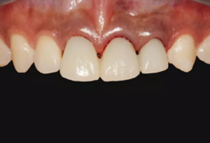 【病例分享】上颌多颗相邻前牙的“精确化”即刻种植修复一例