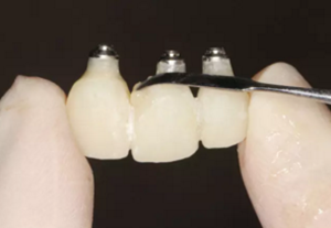 【病例分享】上颌多颗相邻前牙的“精确化”即刻种植修复一例