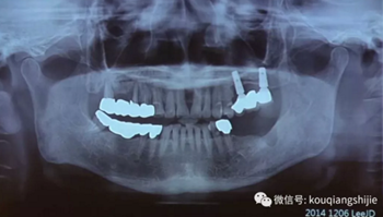 拔牙窝的处理-新思路