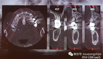 拔牙窝的处理-新思路