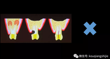 拔牙窝的处理-新思路