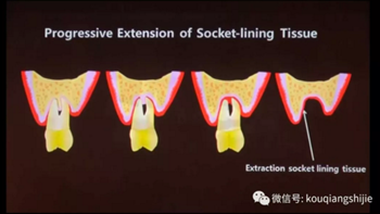 拔牙窝的处理-新思路