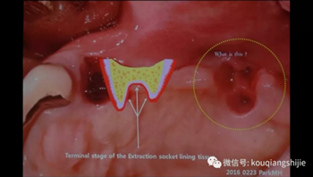 拔牙窝的处理-新思路