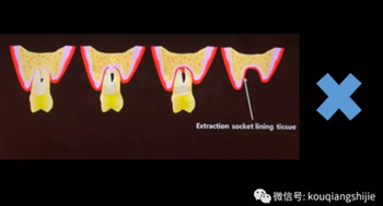 拔牙窝的处理-新思路