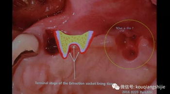 拔牙窝的处理-新思路