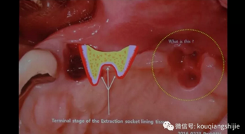 拔牙窝的处理-新思路