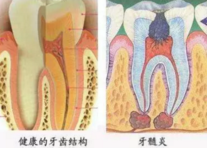 牙髓症状的鉴别