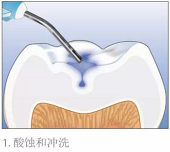 牙齿从针眼大的洞到拔除，步步惊心！