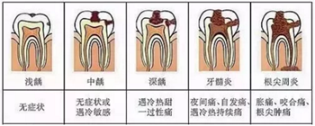 牙齿从针眼大的洞到拔除，步步惊心！