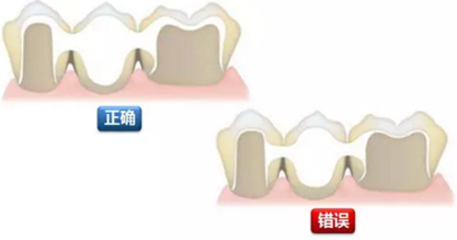 全锆牙冠裂原因分析—操作流程工艺以及患者日常使用