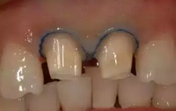 双线排龈在口腔临床冠修复上的应用
