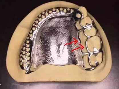 活动义齿修复，要懂的钢托设计