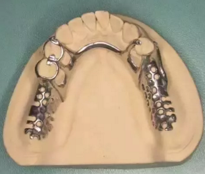 活动义齿修复，要懂的钢托设计