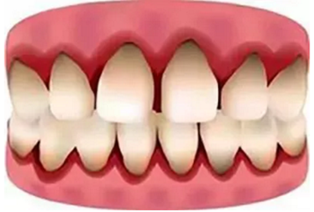 最可怕的牙病——牙龈萎缩