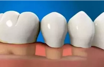 最可怕的牙病——牙龈萎缩