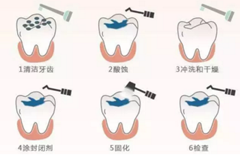 关于窝沟封闭