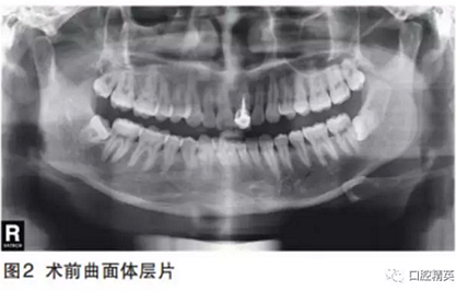 前牙即刻种植并个性化基台美学修复