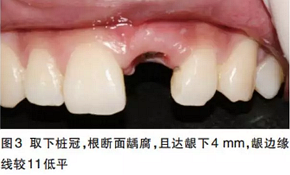 前牙即刻种植并个性化基台美学修复