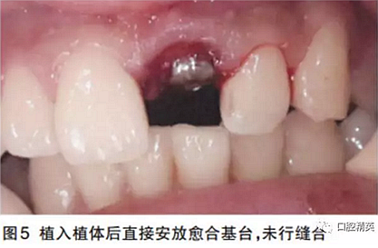 前牙即刻种植并个性化基台美学修复