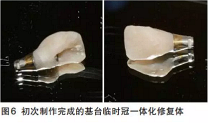 前牙即刻种植并个性化基台美学修复