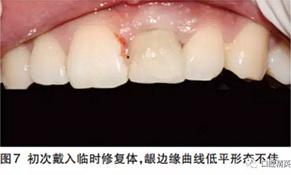 前牙即刻种植并个性化基台美学修复