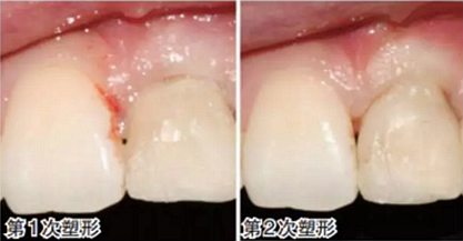 前牙即刻种植并个性化基台美学修复