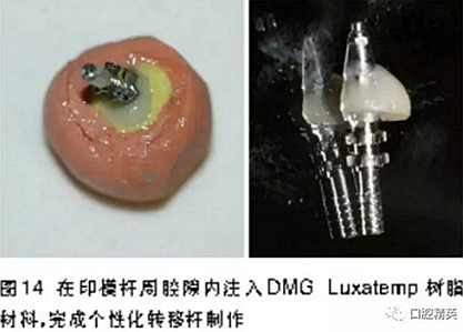 前牙即刻种植并个性化基台美学修复