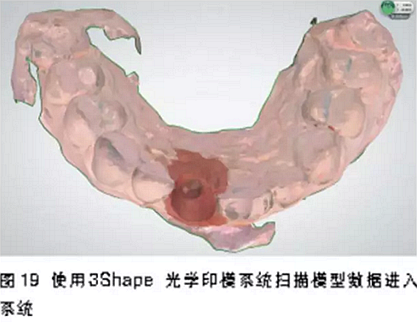 前牙即刻种植并个性化基台美学修复