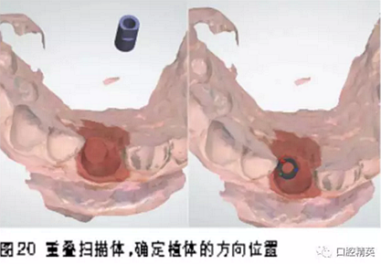 前牙即刻种植并个性化基台美学修复