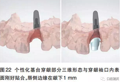 前牙即刻种植并个性化基台美学修复