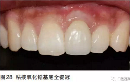 前牙即刻种植并个性化基台美学修复