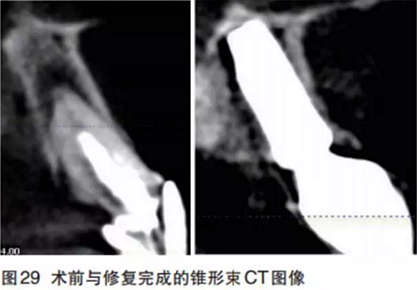 前牙即刻种植并个性化基台美学修复