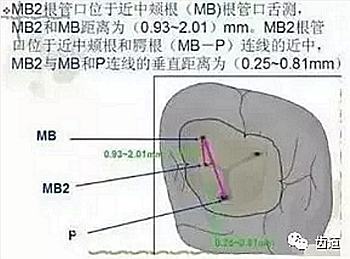 根管治疗常见的难点与解决方案