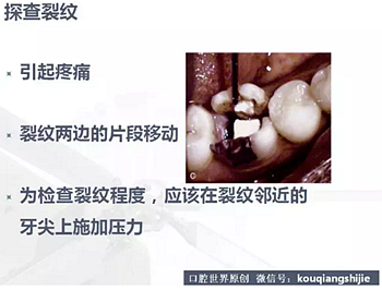 牙根纵裂