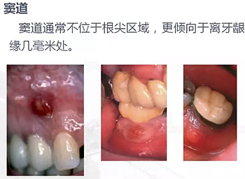 牙根纵裂